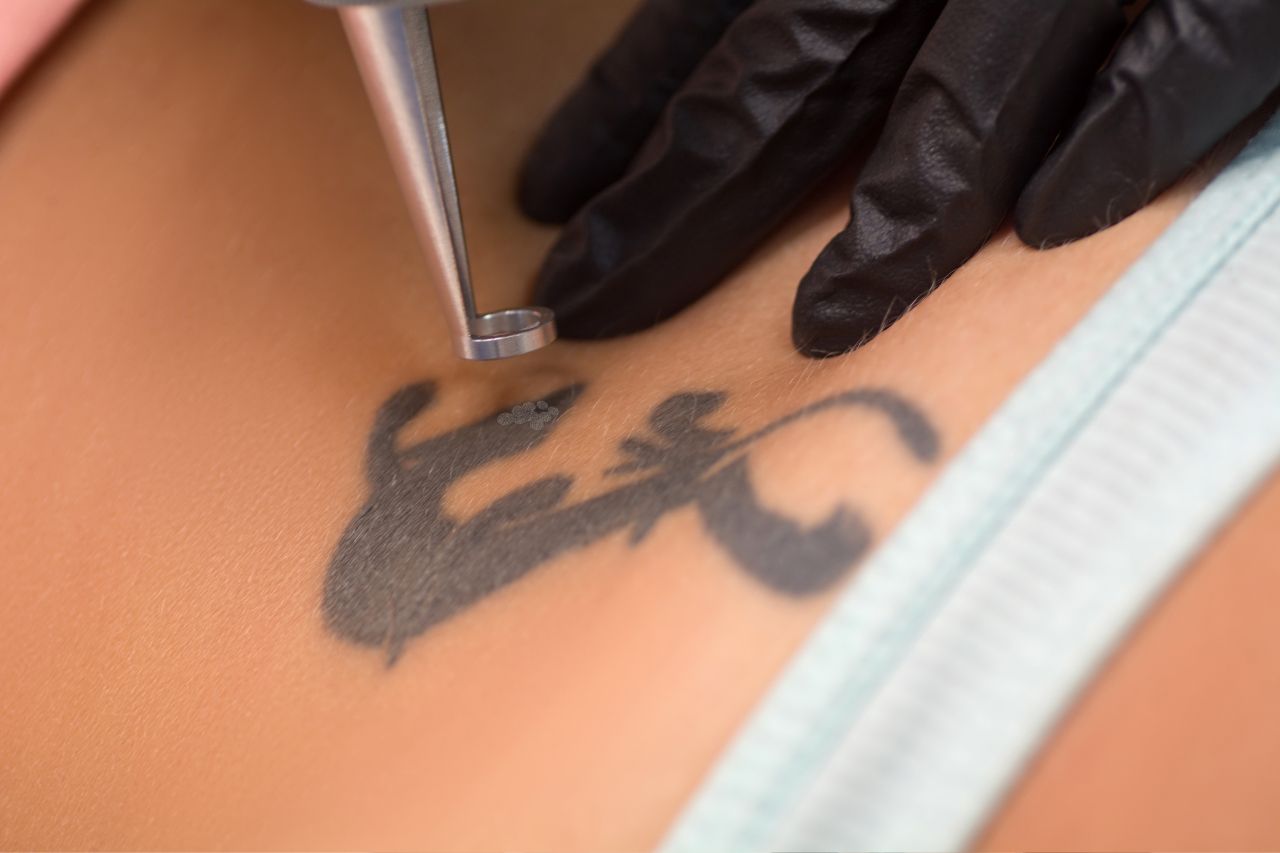Rimozione dei Tatuaggi e Tipi di Pelle: Cosa Sapere